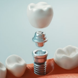 Dental implant